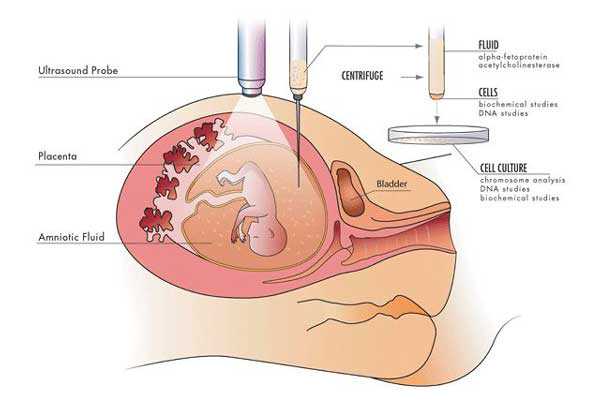香港验血鉴定男女价格,宫腔积液如何影响辅助生殖技术中助孕过程？